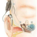 como-funcionan-los-implantes-cocleares Implantes Cocleares