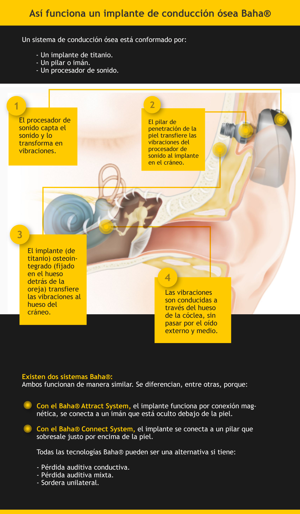 Tecnología de implantes Cochlear