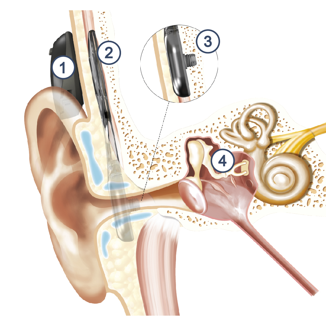 Hipoacusia Implantes Cocleares Soluciones Y Beneficios 6169