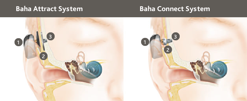 Soluciones-quirúrgicas-Baha-Attract-Baha-connect